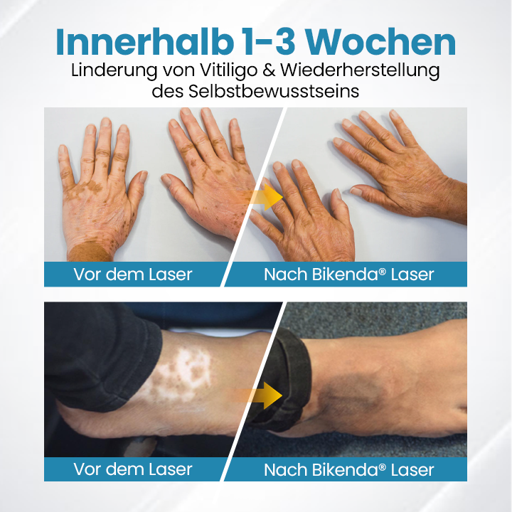 Bikenda® DermaBeam Vitiligo-Therapiegerät