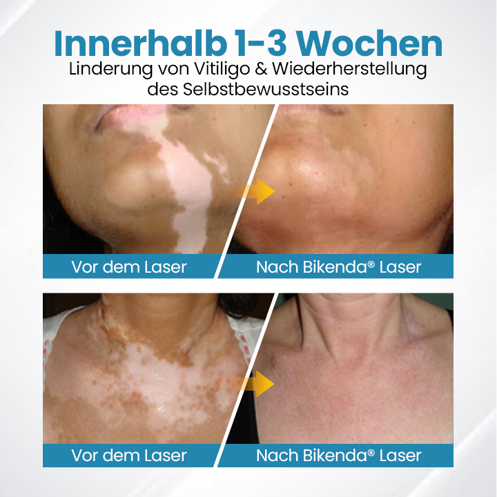 Bikenda® DermaBeam Vitiligo-Therapiegerät