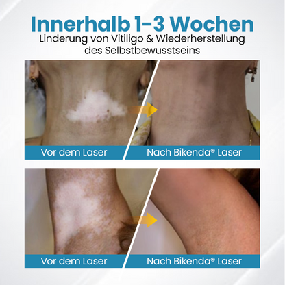 Bikenda® DermaBeam Vitiligo-Therapiegerät