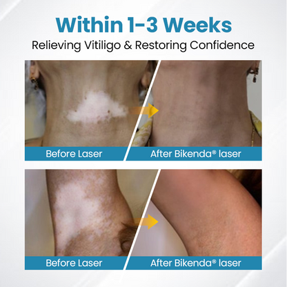 Bikenda® DermaBeam Vitiligo-Therapiegerät