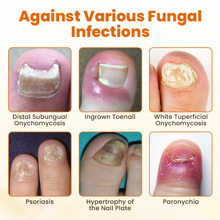 Timilk® FungiBee Fortschrittliches Nagelreparatur-Spray⚕️