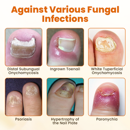 Timilk® FungiBee Fortschrittliches Nagelreparatur-Spray⚕️