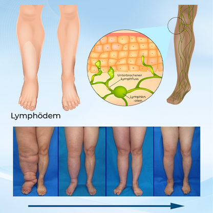 ✅ Offizieller Shop: Timilk® LymphoEase Magnesium PCA Roll-On Linderungscreme 🔥 FDA-zertifiziert (Klinisch erwiesene Linderung bei Lymphödemen, Beinschwellungen und schlechter Durchblutung 🩺)