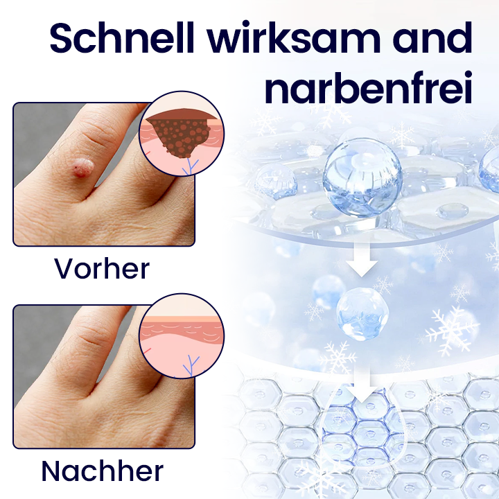 Timilk® WartErase Kryo-Freeze Spray