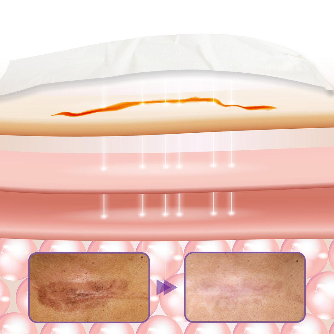 Timilk® HyaRepair Mikronadel-Hautpflaster