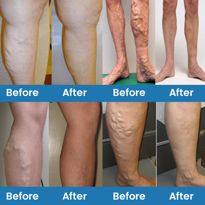 Timilk® VeinFlow Microneedle Repair Patch